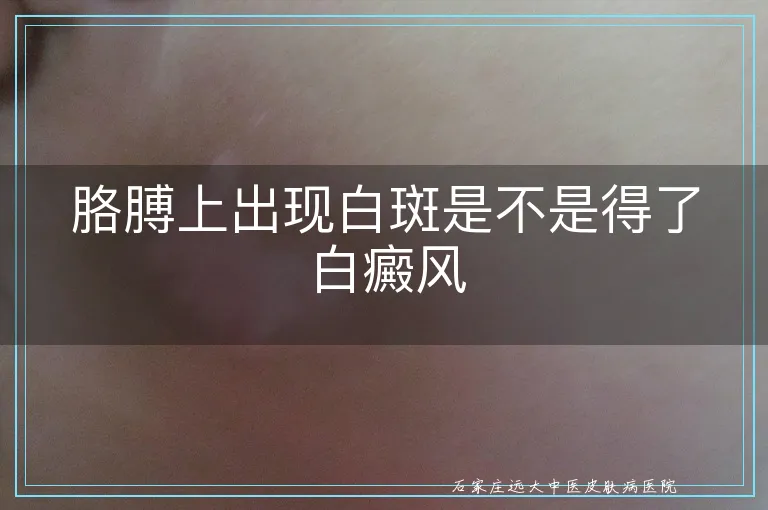 胳膊上出现白斑是不是得了白癜风