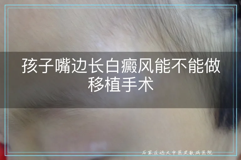 孩子嘴边长白癜风能不能做移植手术