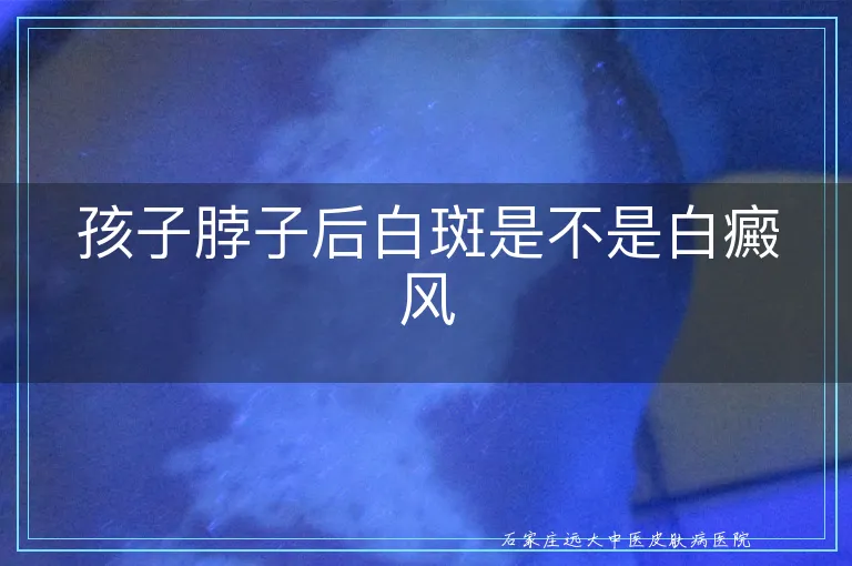孩子脖子后白斑是不是白癜风