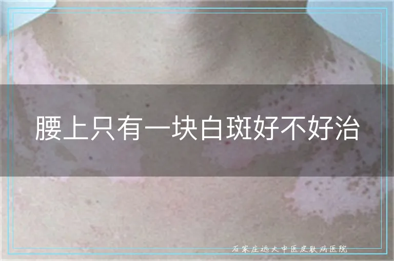 腰上只有一块白斑好不好治