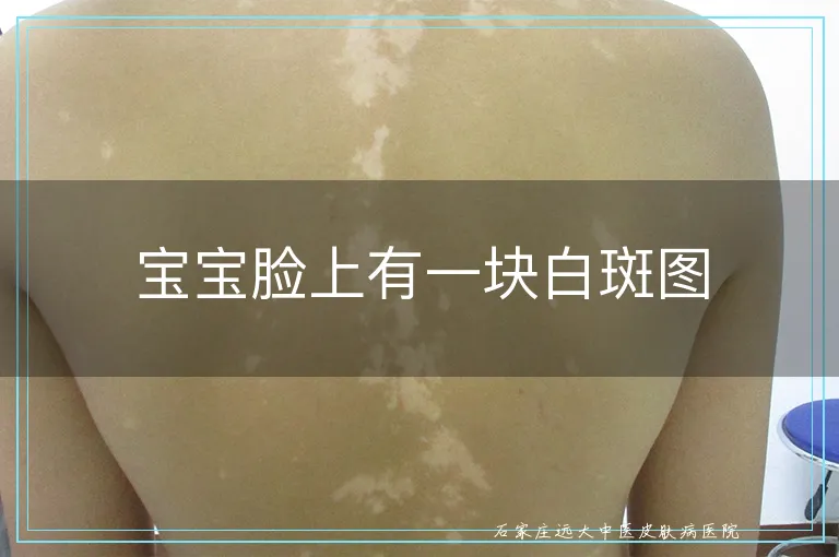 宝宝脸上有一块白斑图