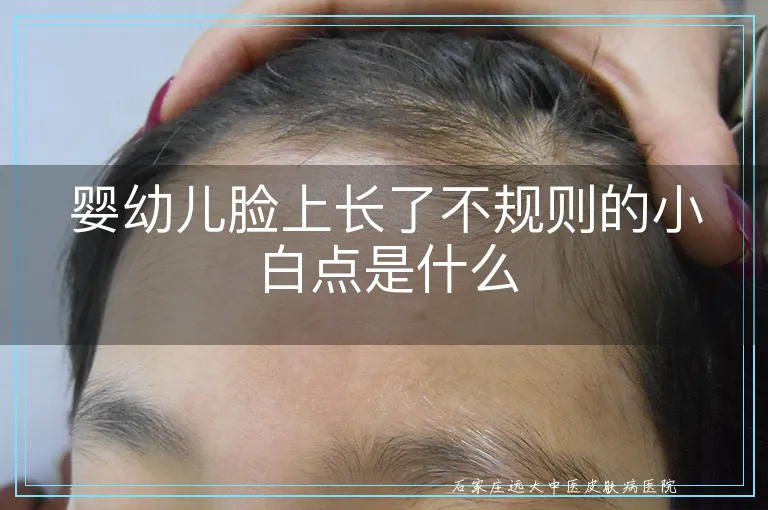 婴幼儿脸上长了不规则的小白点是什么