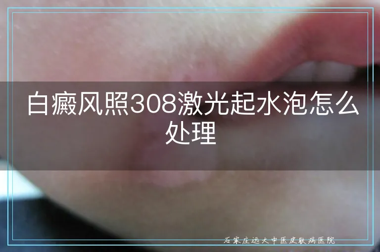 白癜风照308激光起水泡怎么处理