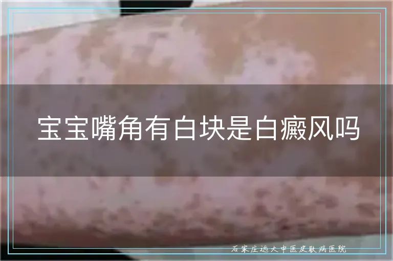 宝宝嘴角有白块是白癜风吗