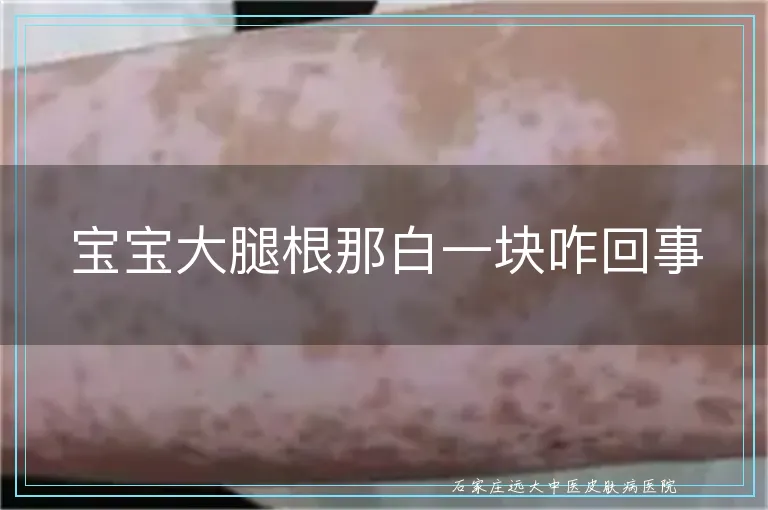 宝宝大腿根那白一块咋回事