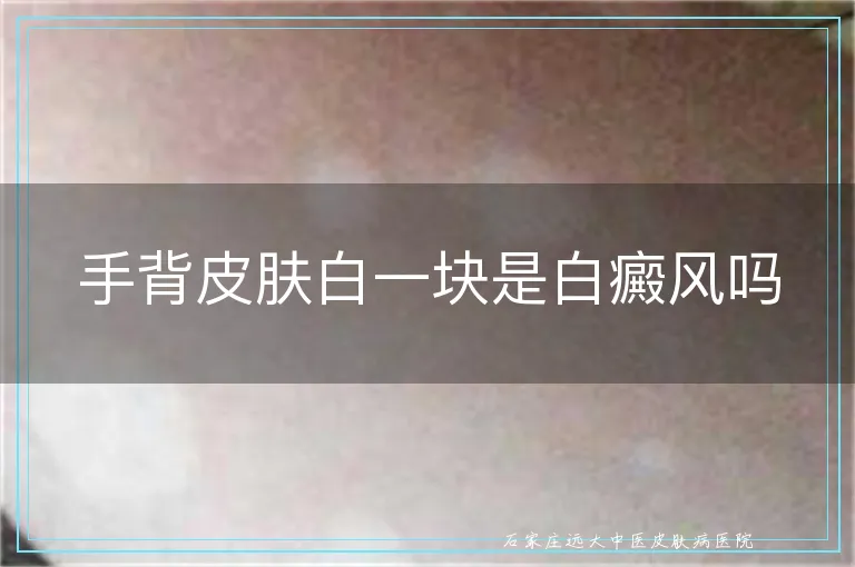 手背皮肤白一块是白癜风吗