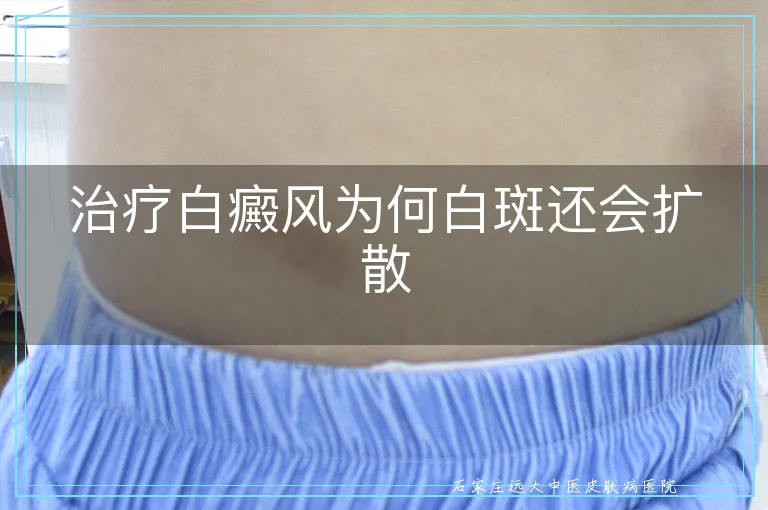 治疗白癜风为何白斑还会扩散