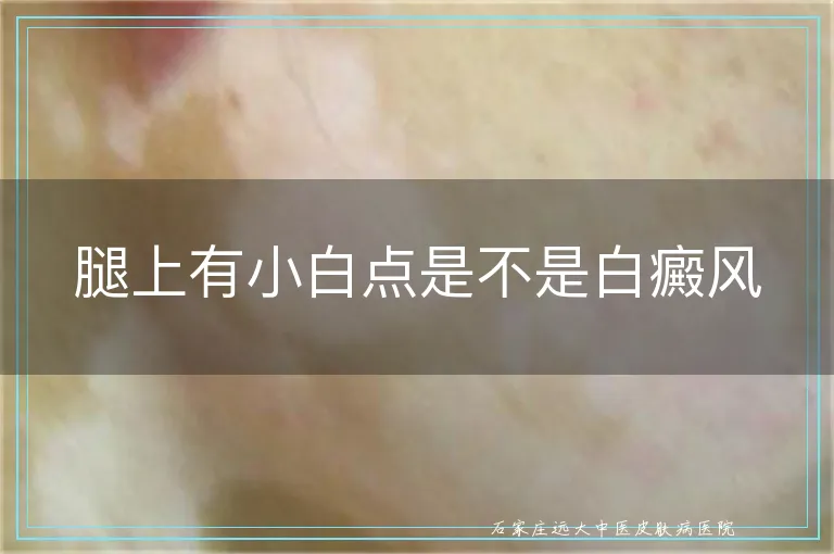腿上有小白点是不是白癜风