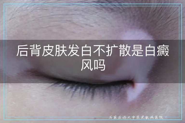 后背皮肤发白不扩散是白癜风吗