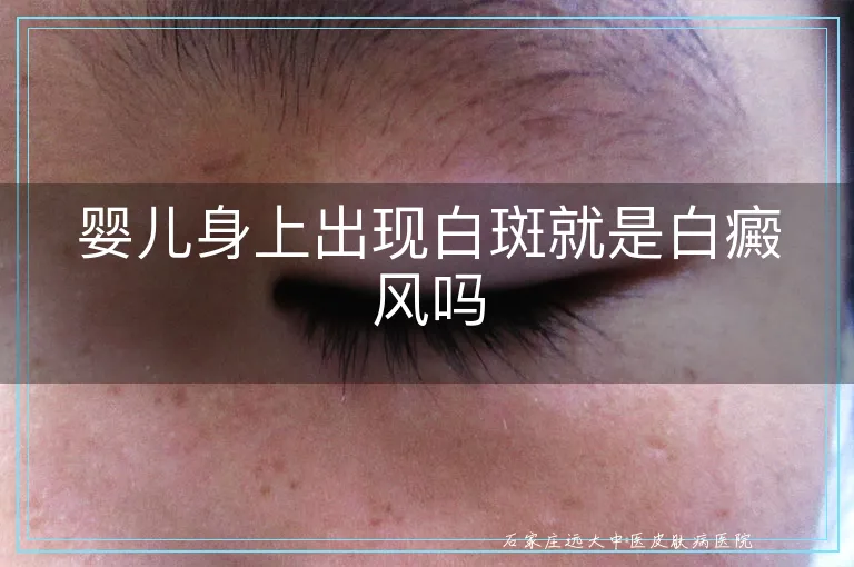 婴儿身上出现白斑就是白癜风吗