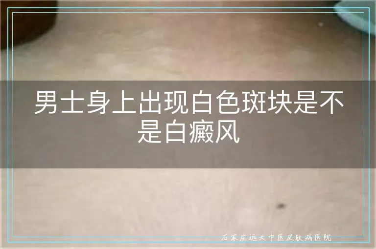 男士身上出现白色斑块是不是白癜风