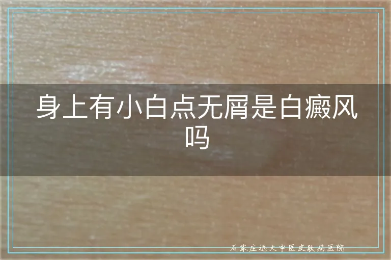 身上有小白点无屑是白癜风吗