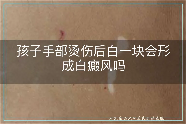 孩子手部烫伤后白一块会形成白癜风吗