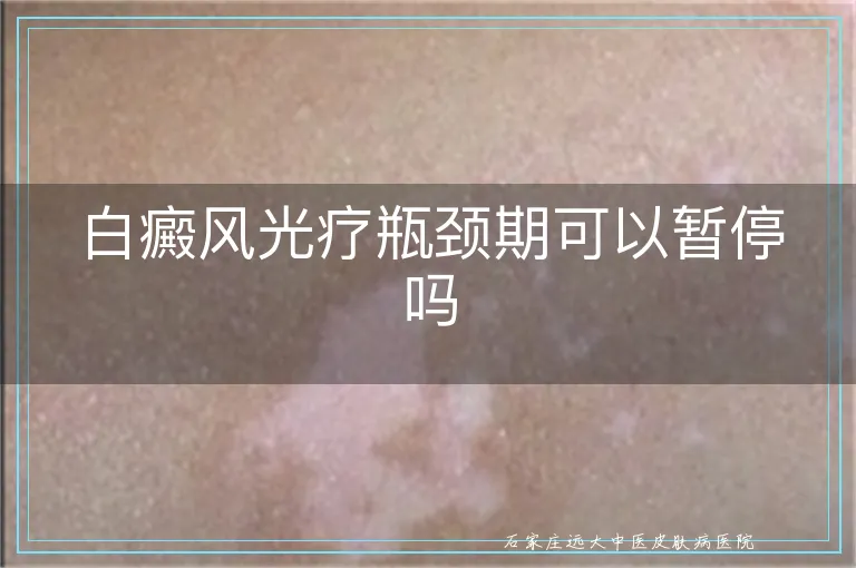 白癜风光疗瓶颈期可以暂停吗