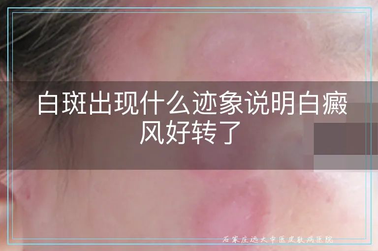 白斑出现什么迹象说明白癜风好转了