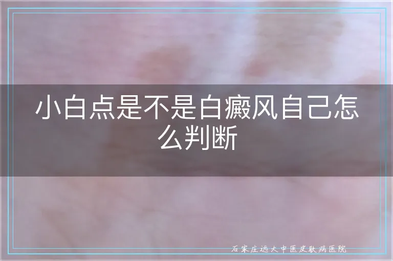 小白点是不是白癜风自己怎么判断
