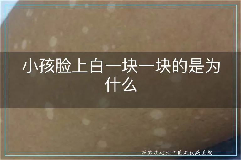 小孩脸上白一块一块的是为什么