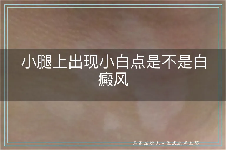 小腿上出现小白点是不是白癜风