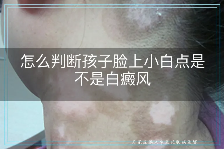 怎么判断孩子脸上小白点是不是白癜风
