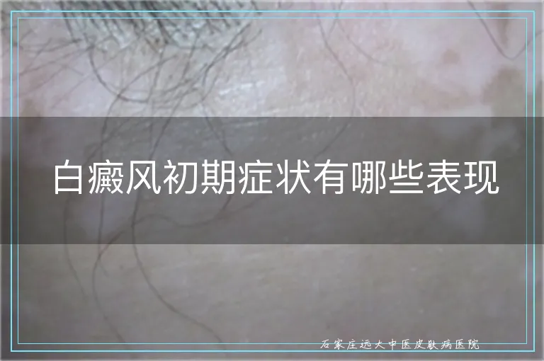 白癜风初期症状有哪些表现