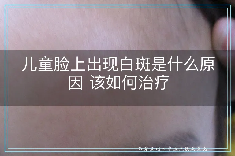 儿童脸上出现白斑是什么原因 该如何治疗