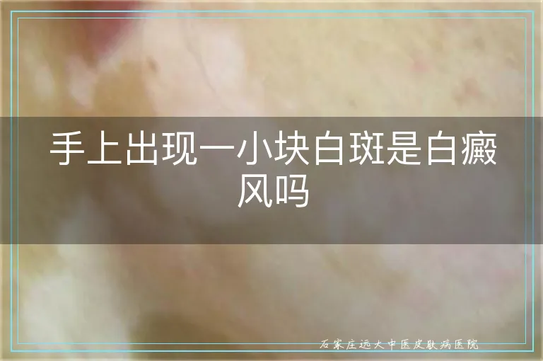 手上出现一小块白斑是白癜风吗