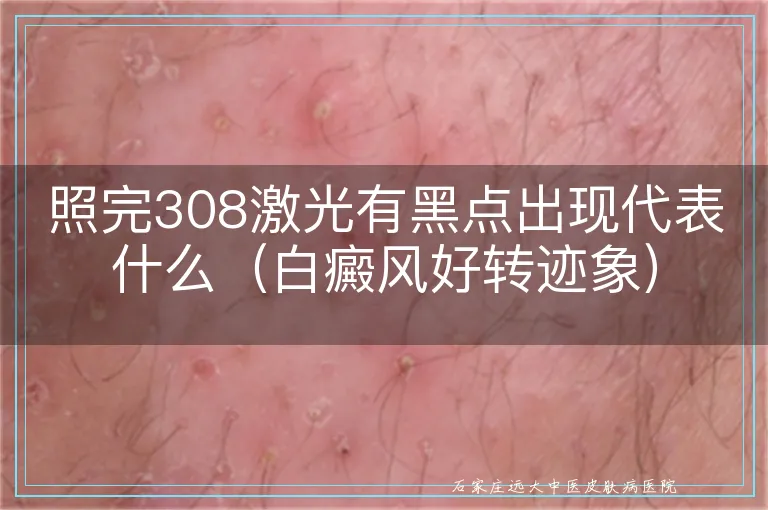 照完308激光有黑点出现代表什么（白癜风好转迹象）