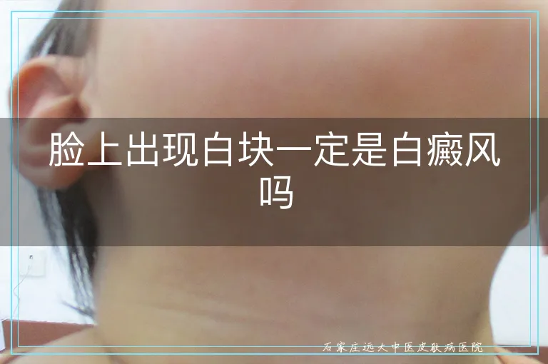 脸上出现白块一定是白癜风吗