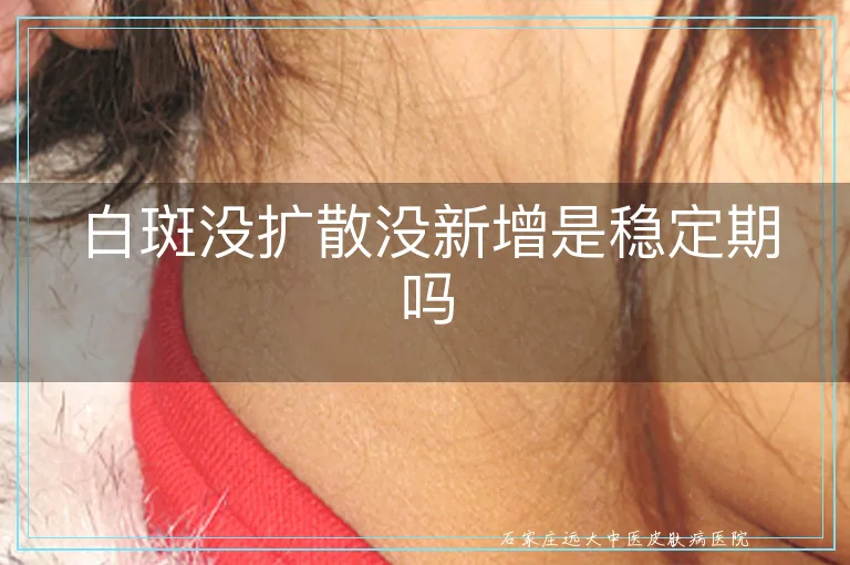 白斑没扩散没新增是稳定期吗