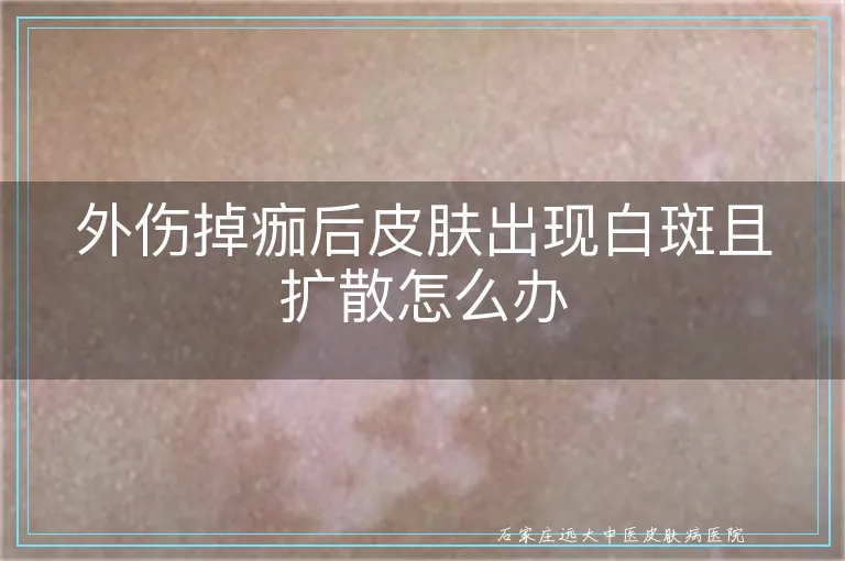 外伤掉痂后皮肤出现白斑且扩散怎么办