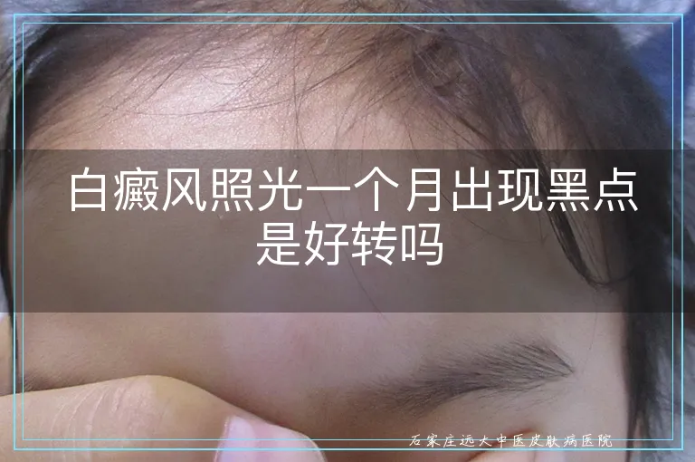 白癜风照光一个月出现黑点是好转吗