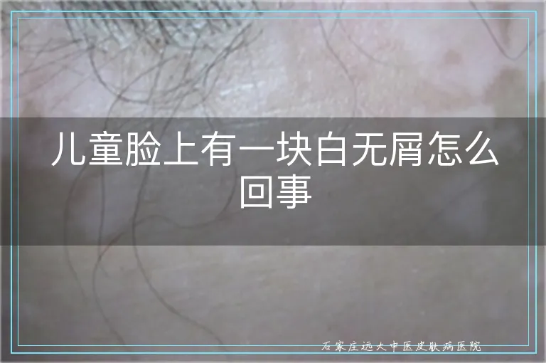 儿童脸上有一块白无屑怎么回事
