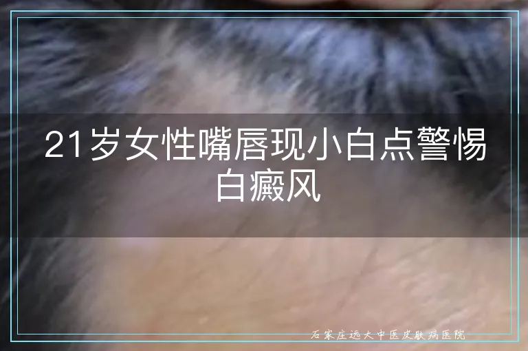 21岁女性嘴唇现小白点警惕白癜风