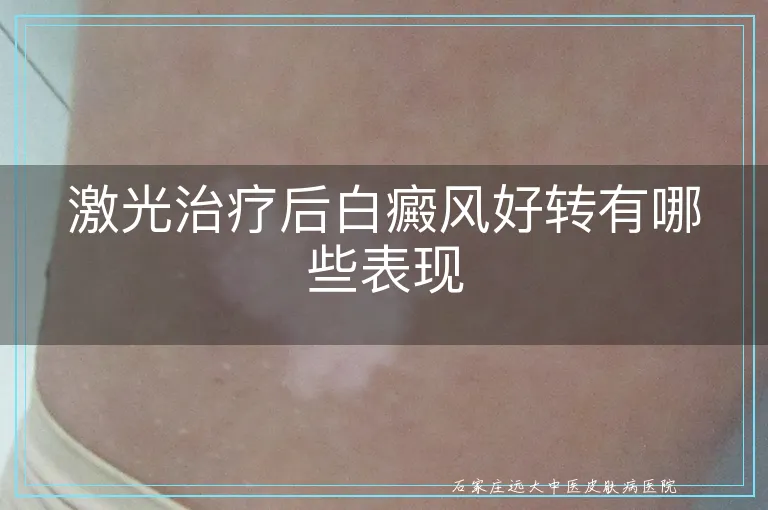 激光治疗后白癜风好转有哪些表现