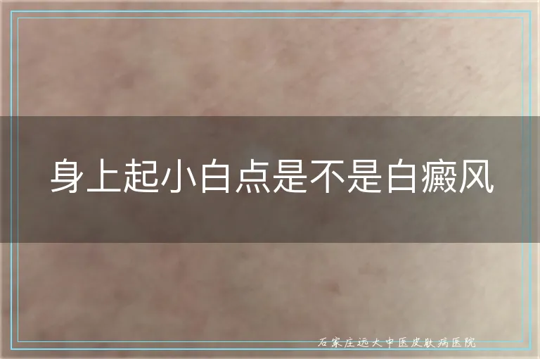 身上起小白点是不是白癜风