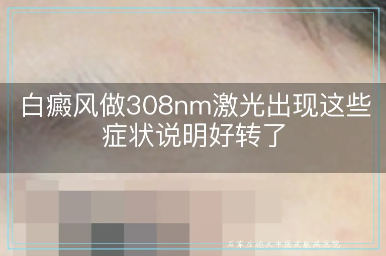 白癜风做308nm激光出现这些症状说明好转了