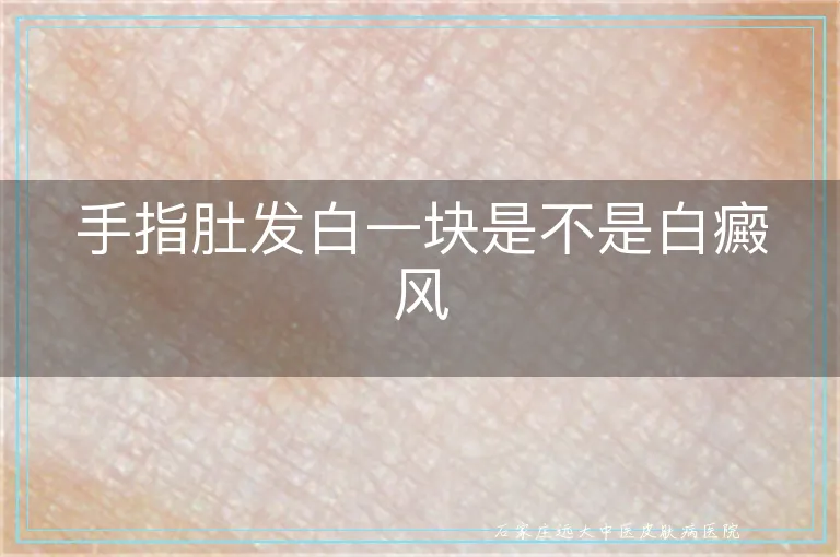 手指肚发白一块是不是白癜风