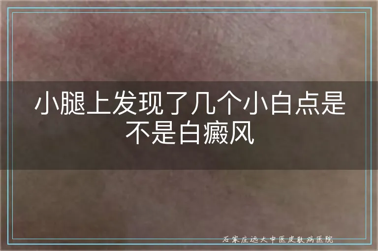 小腿上发现了几个小白点是不是白癜风