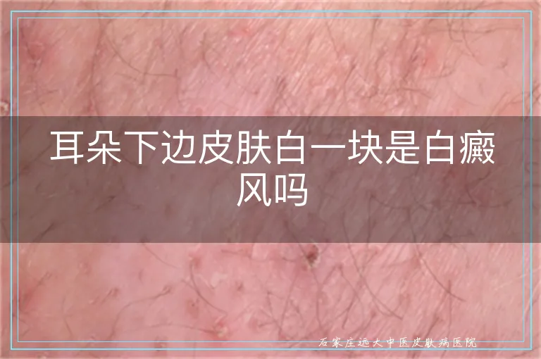 耳朵下边皮肤白一块是白癜风吗