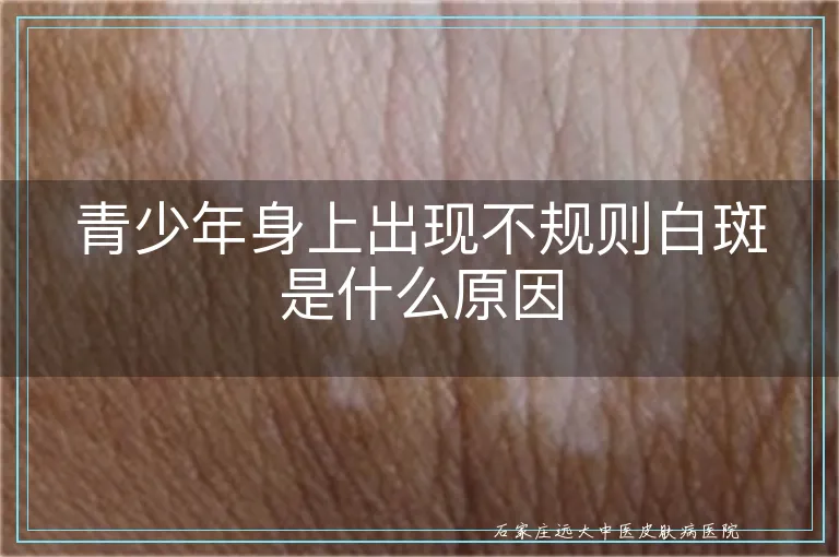 青少年身上出现不规则白斑是什么原因