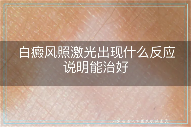 白癜风照激光出现什么反应说明能治好