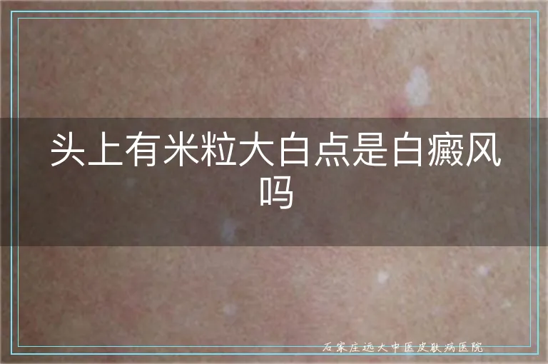 头上有米粒大白点是白癜风吗