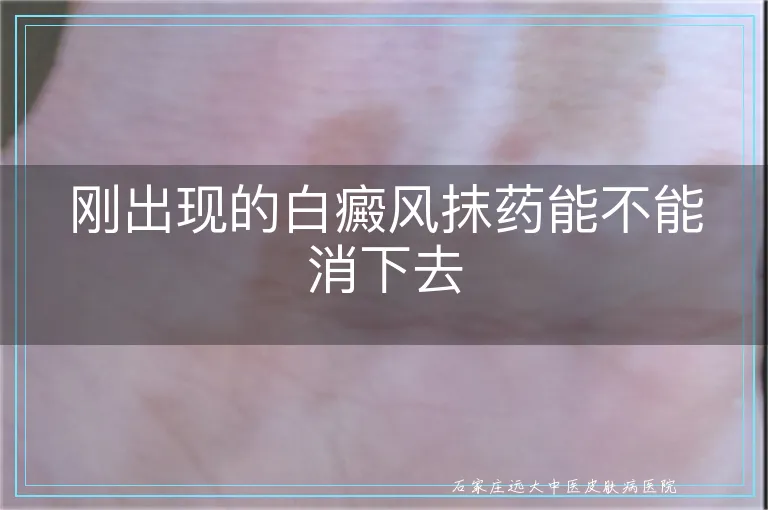 刚出现的白癜风抹药能不能消下去