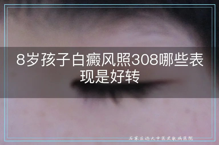 8岁孩子白癜风照308哪些表现是好转