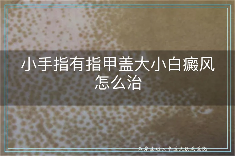 小手指有指甲盖大小白癜风怎么治