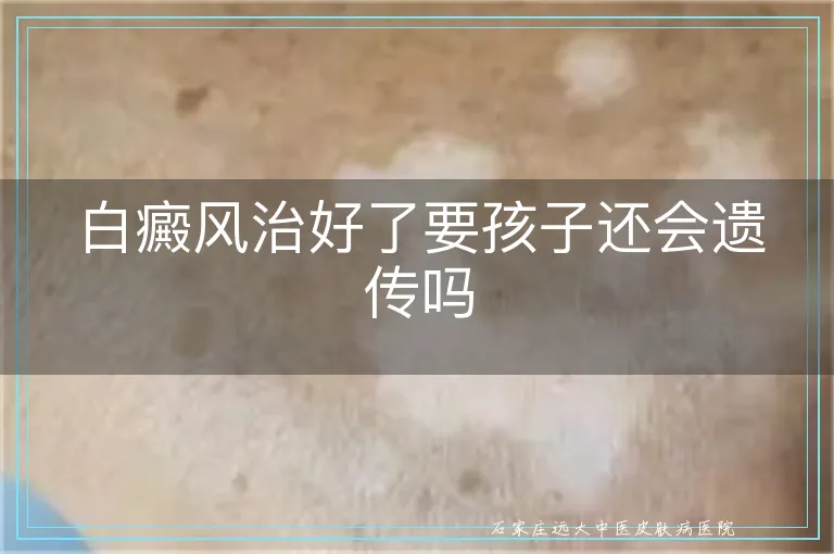 白癜风治好了要孩子还会遗传吗