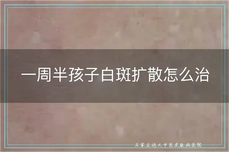 一周半孩子白斑扩散怎么治