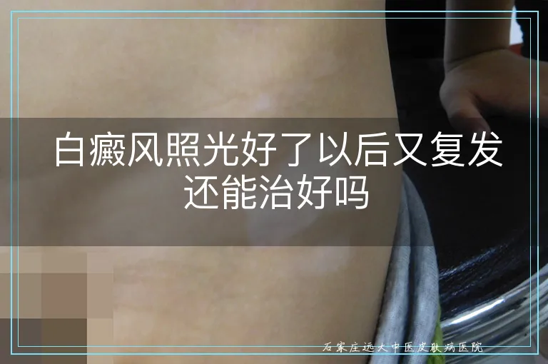 白癜风照光好了以后又复发还能治好吗