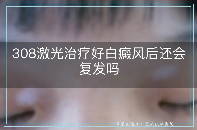 308激光治疗好白癜风后还会复发吗
