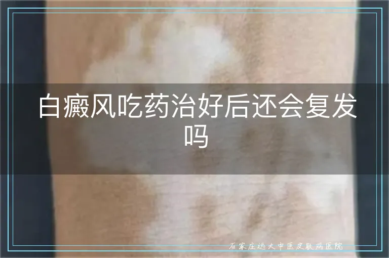 白癜风吃药治好后还会复发吗
